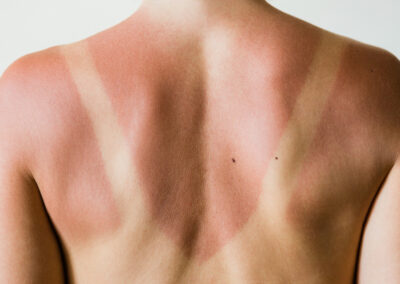Foto eines Sonnenbrandes am Rücken